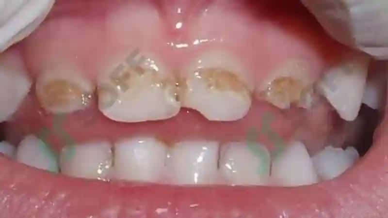 Emal va dentin kasalliklari: gipoplaziya, karies, gipofosfataziya, flyuroz 5