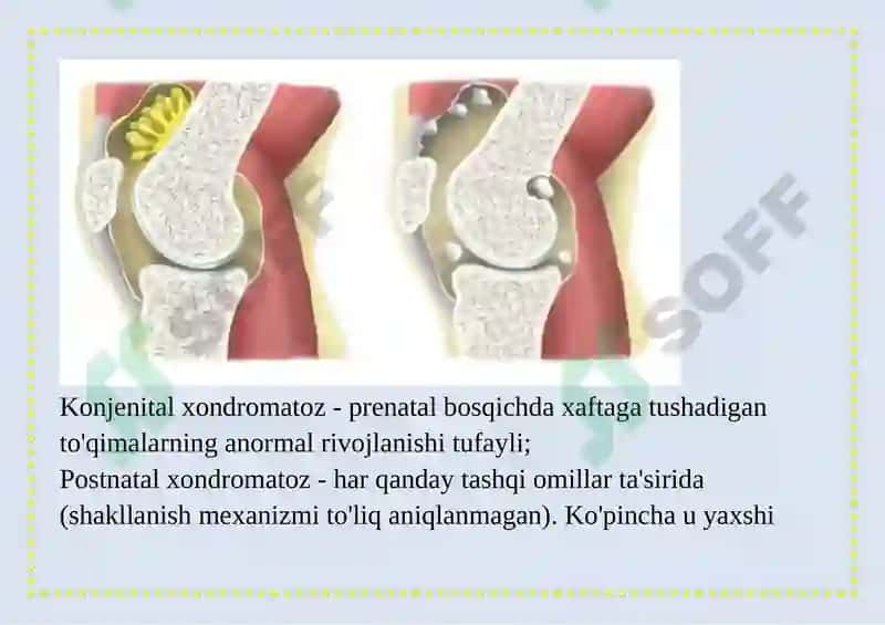 TIZZA XONDROMATOZI 6