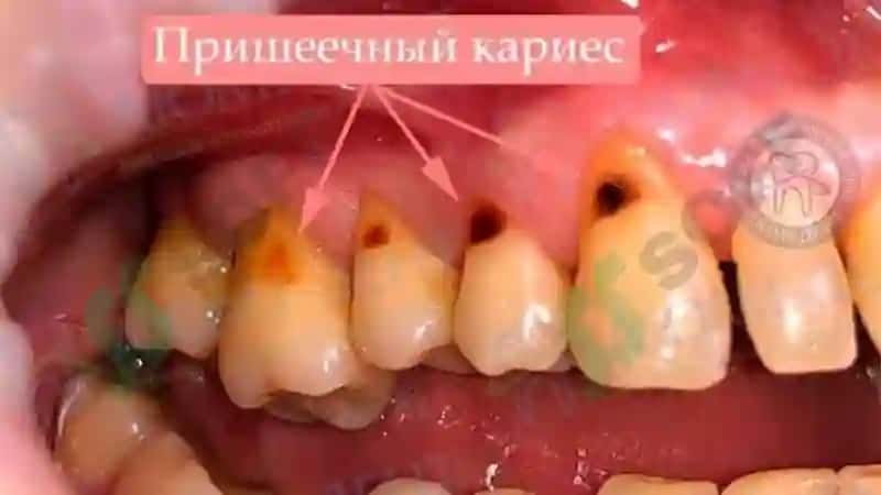Emal va dentin kasalliklari: gipoplaziya, karies, gipofosfataziya, flyuroz 7