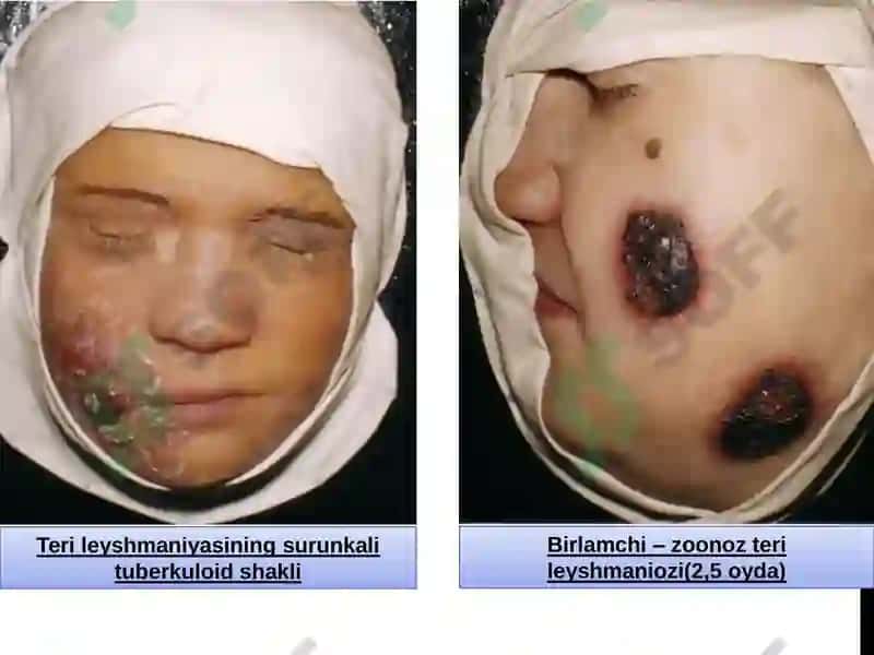 Leyshmaniyalar avlodi (Leishmania) 8