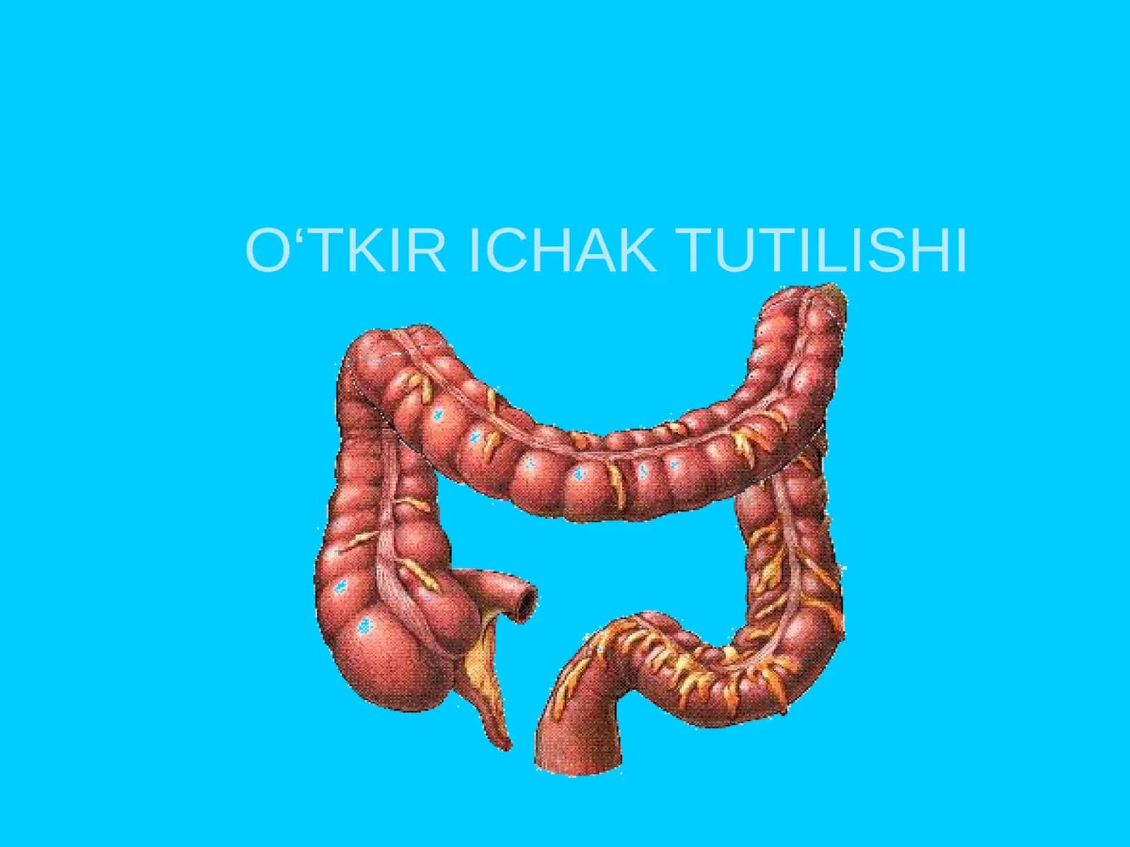 O‘TKIR ICHAK TUTILISHI 1