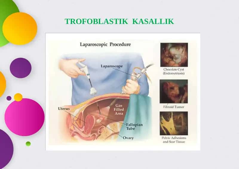 Trofoblastik kasallik 1