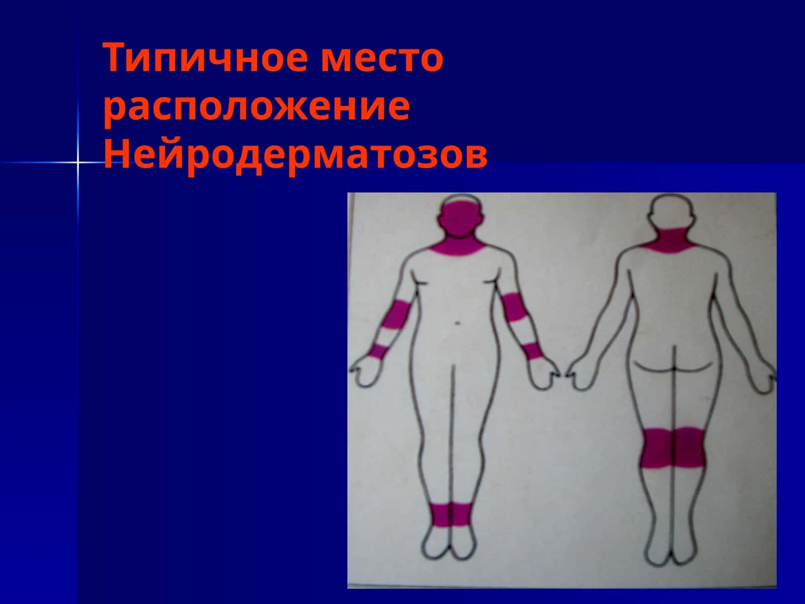 Нейродерматозов 1