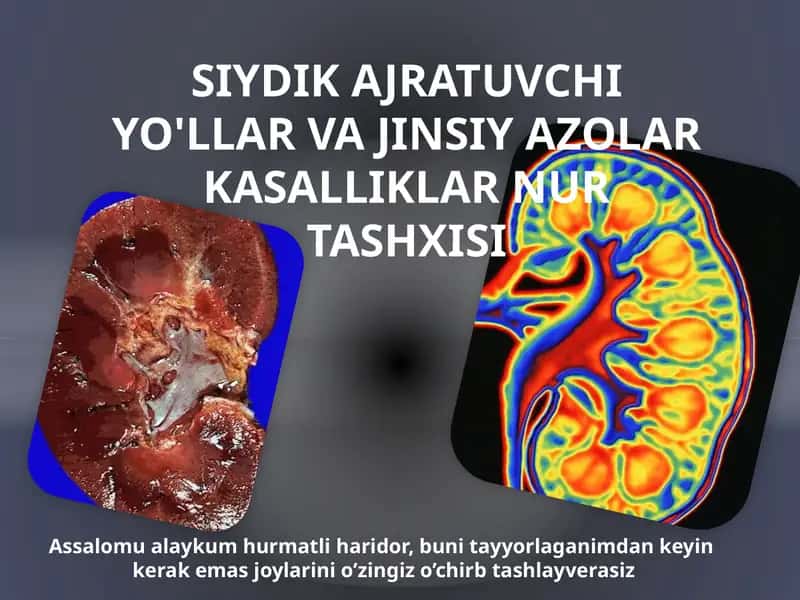 SIYDIK AJRATUVCHI YO'LLAR VA JINSIY AZOLAR KASALLIKLAR NUR TASHXISI 1