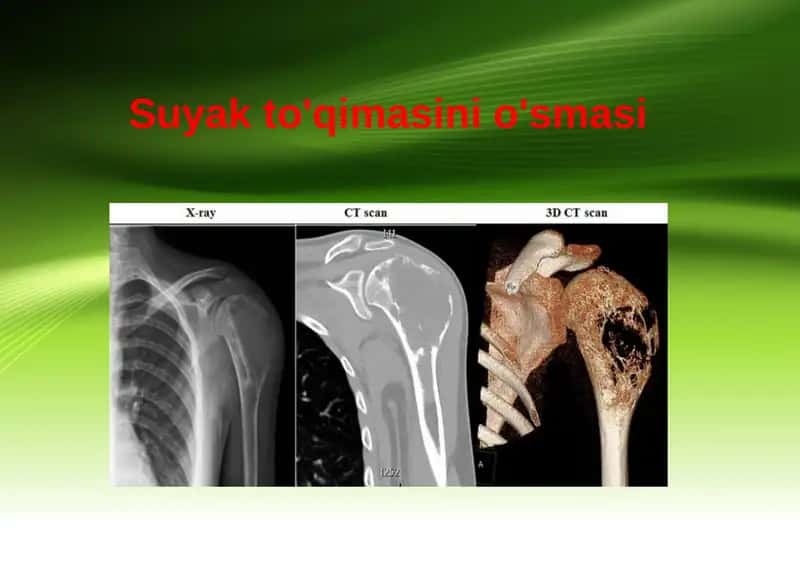Suyak to'qimasini o'smasi 1