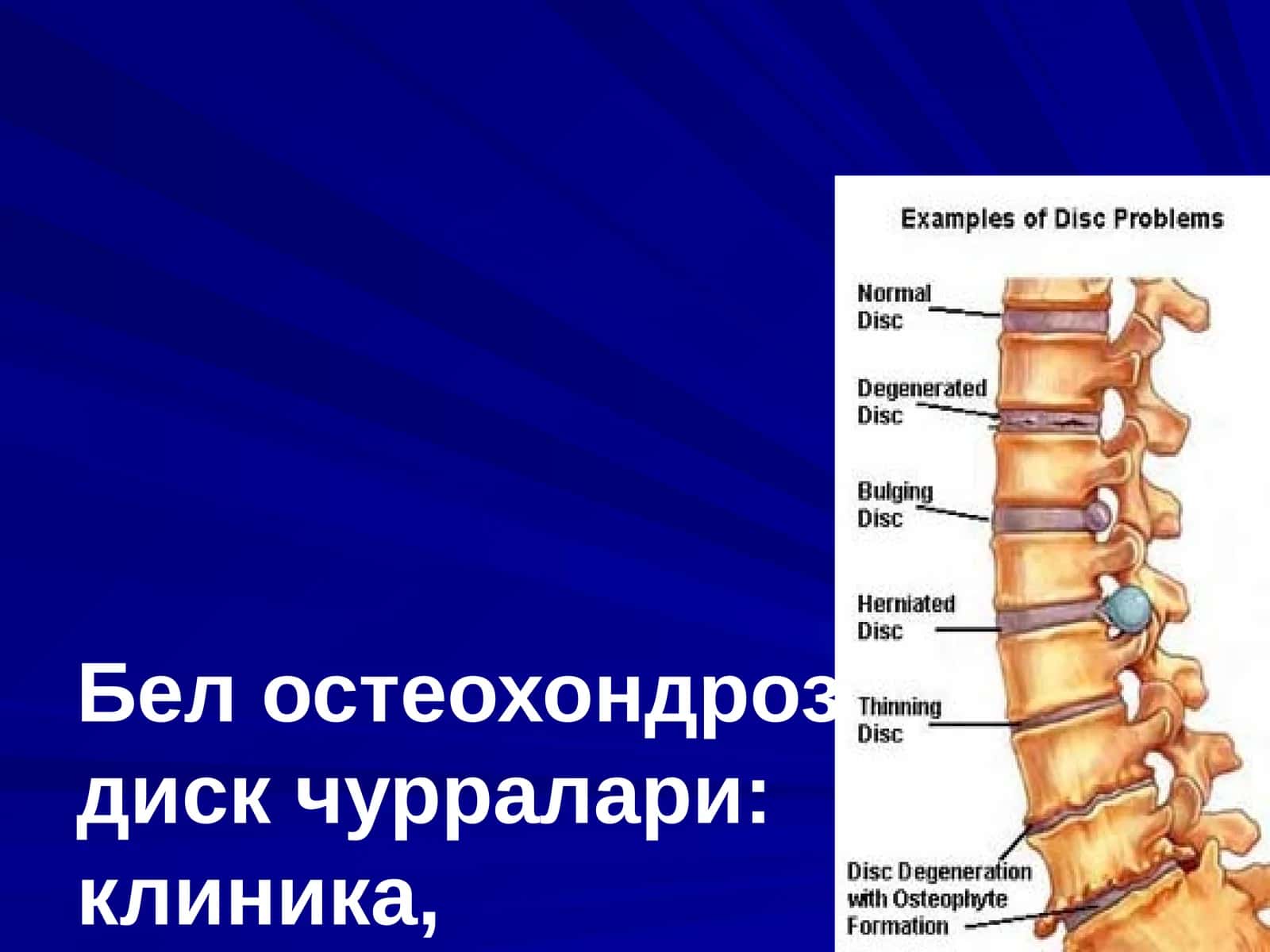 Бел остеохондрози, дискчурралари: клиника, диагностика, хирургик давоси 1