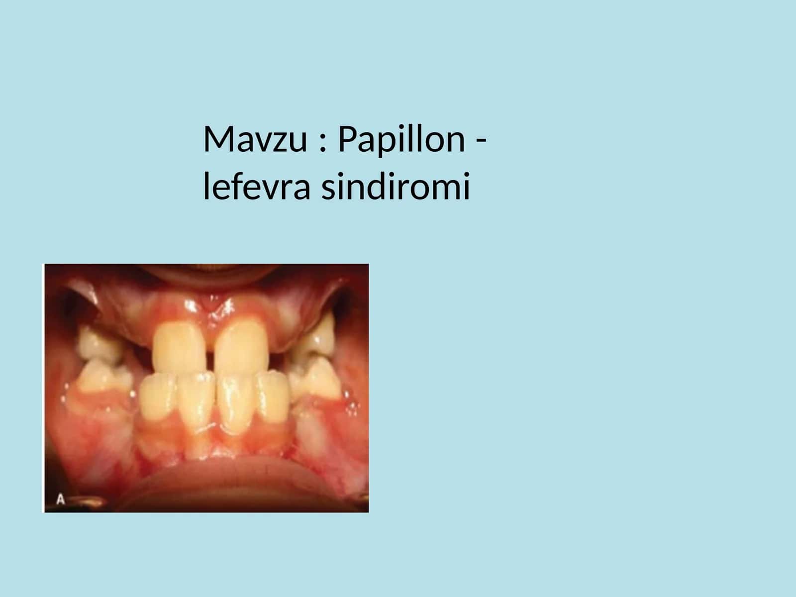 Papillon-Lefevre sindromi 1