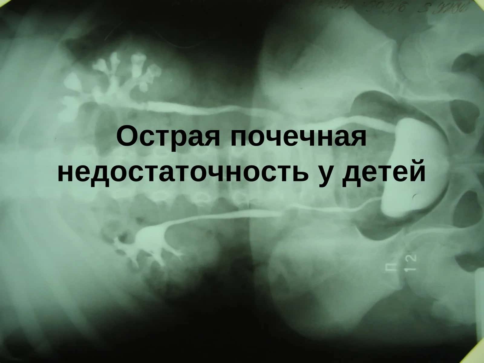 Острая почечная недостаточность у детей 1