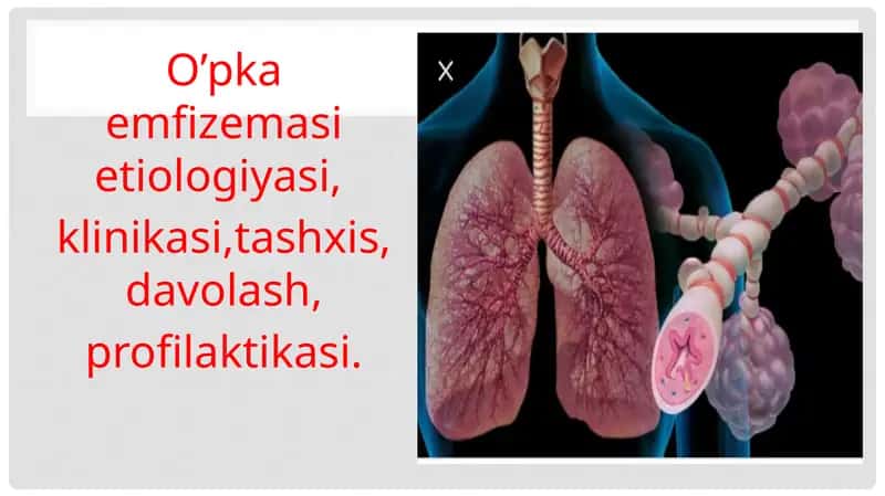 O’pkaemfizemasi etiologiyasi, klinikasi, tashxis, davolash, profilaktikasi 1
