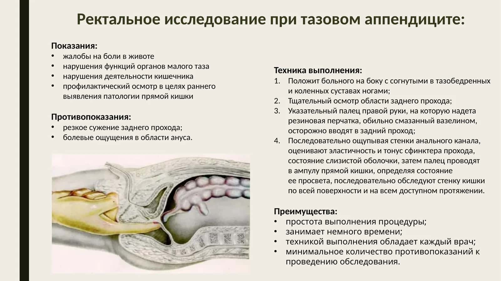 Ректальное исследование при тазовом аппендиците 1