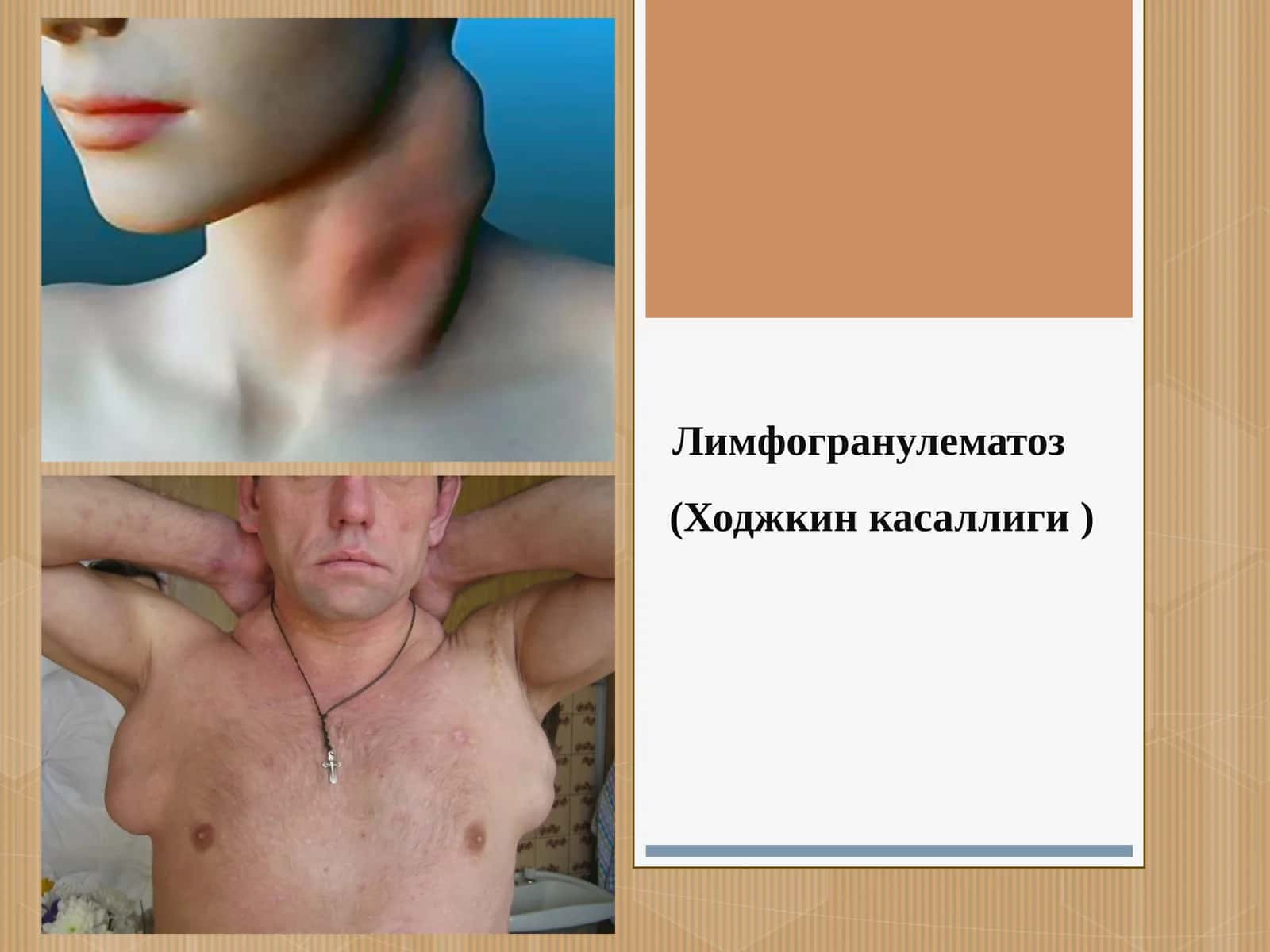 Лимфогранулематоз (Ходжкин касаллиги ) 1