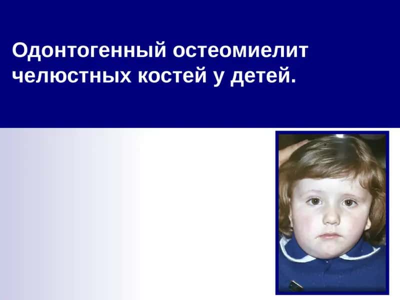 Одонтогенный остеомиелит челюстных костей у детей 1