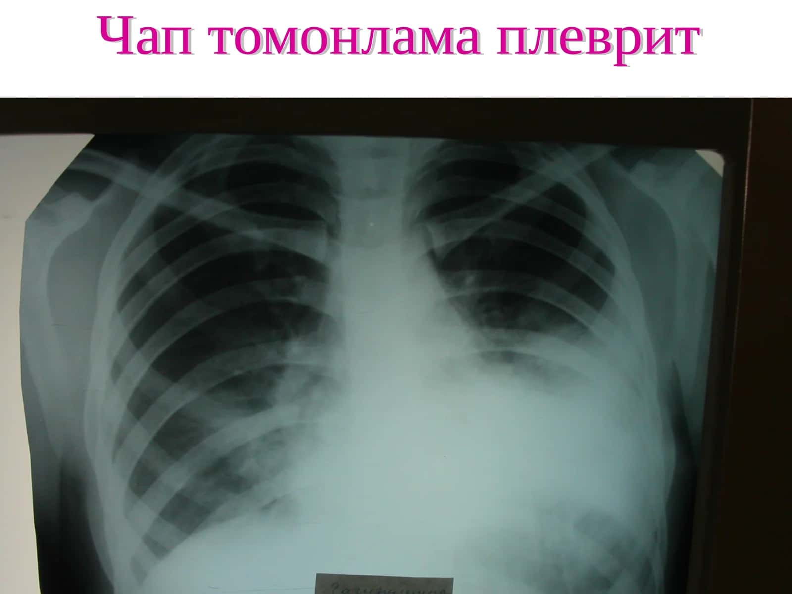 Чап томонлама плеврит 1