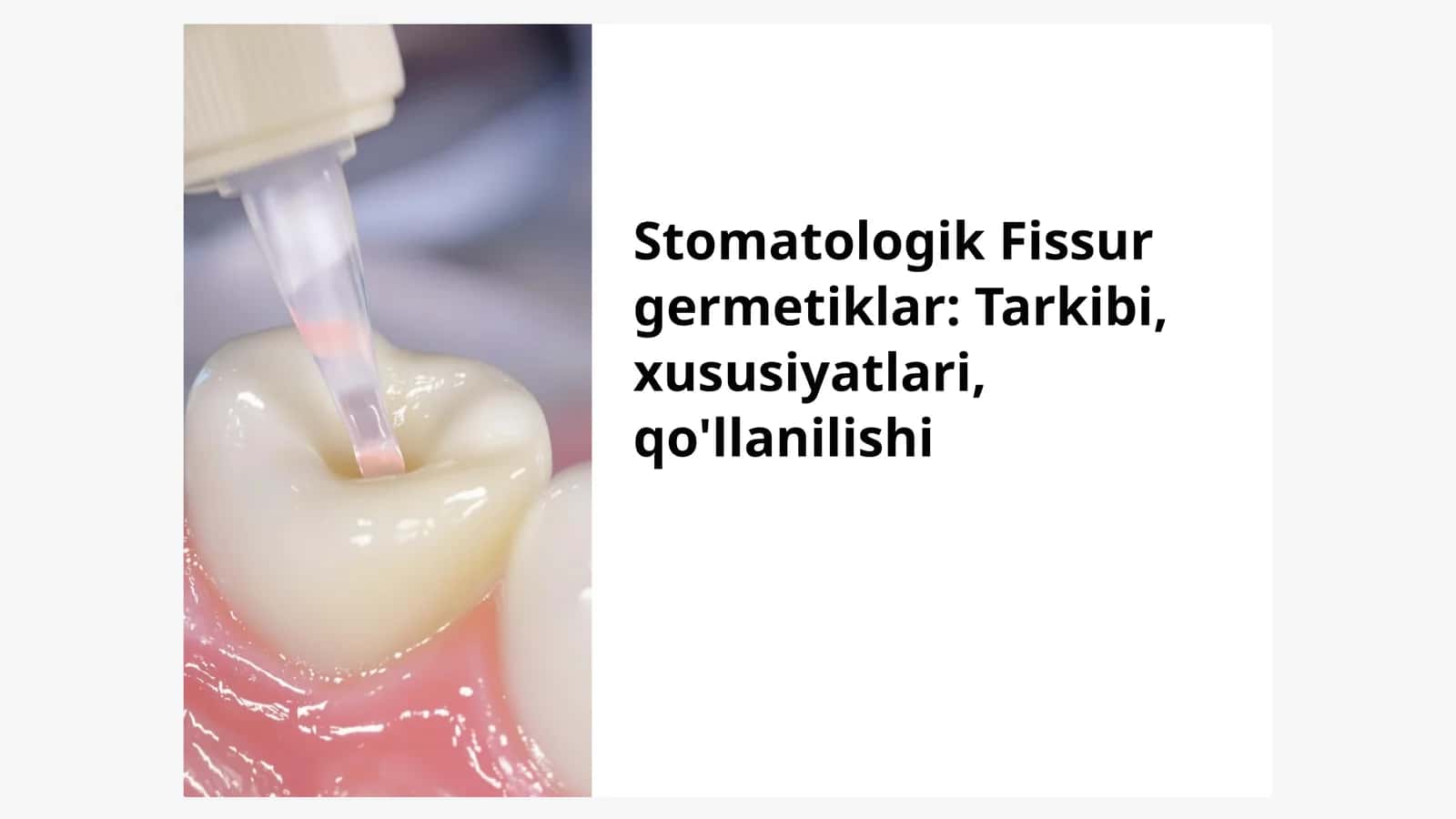 Stomatologik Fissur germetiklar: Tarkibi, xususiyatlari, qo'llanilishi 1