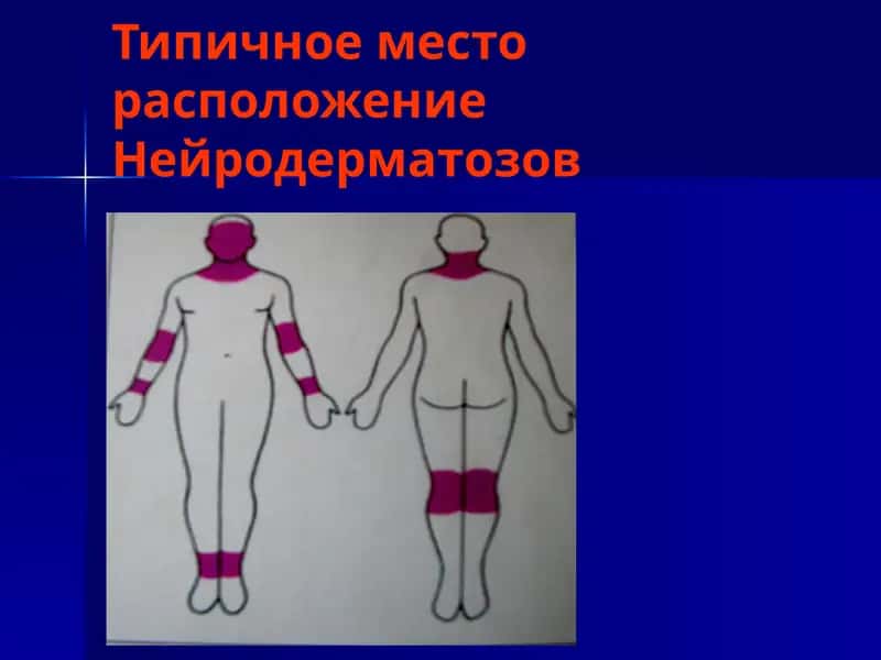 Нейродермит 1