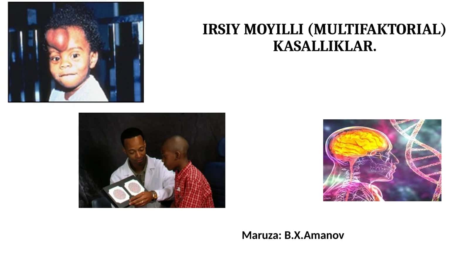 IRSIY MOYILLI (MULTIFAKTORIAL) KASALLIKLAR 1