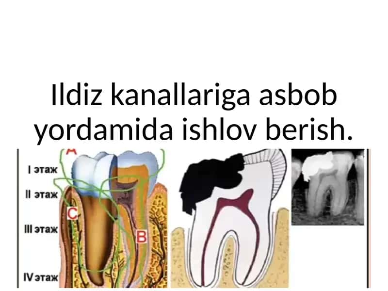 Ildiz kanallariga asbob yordamida ishlov berish 1