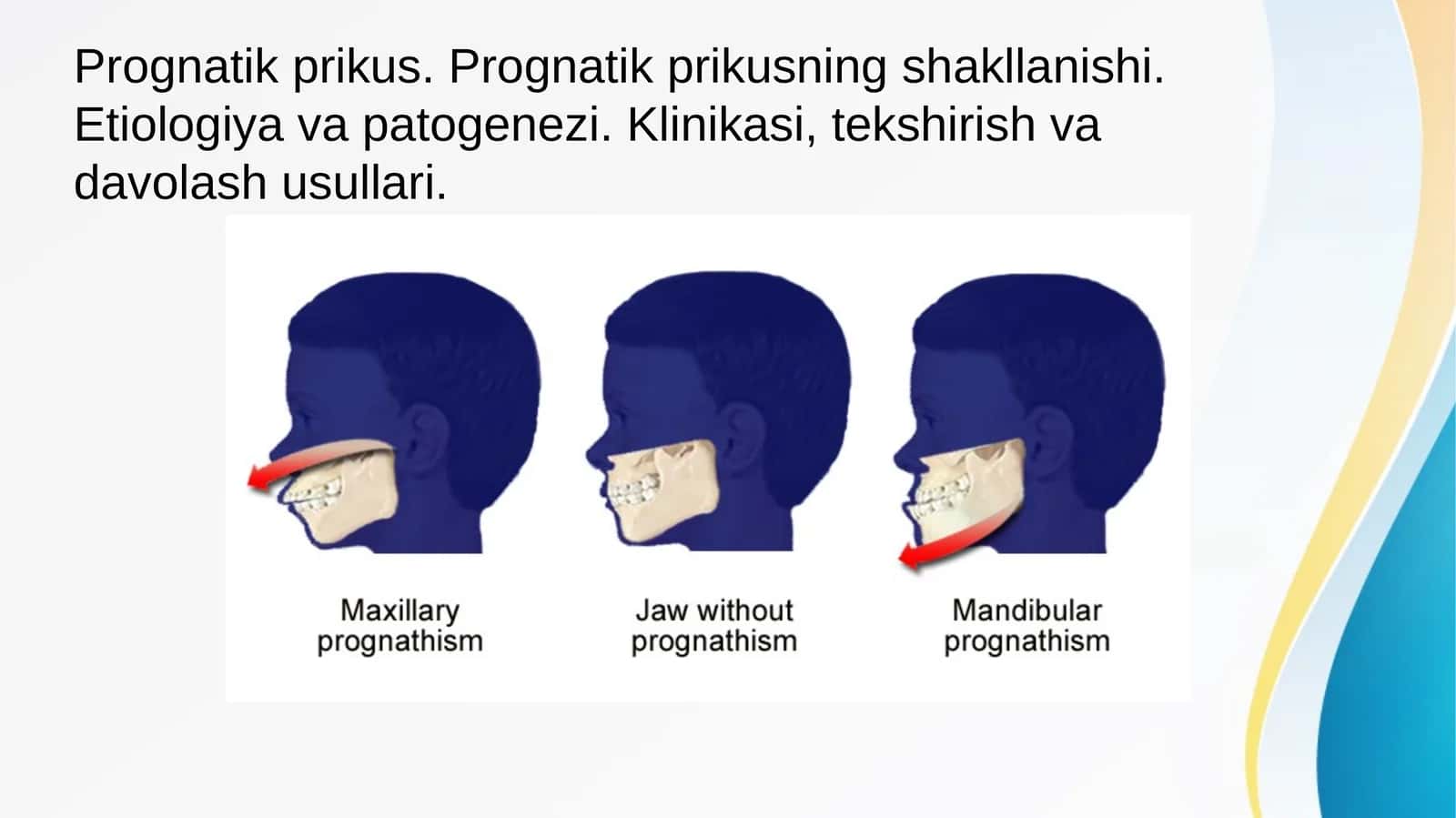 Prognatik prikus. Prognatik prikusning shakllanishi. Etiologiya va patogenezi. Klinikasi, tekshirish va davolash usullari. 1