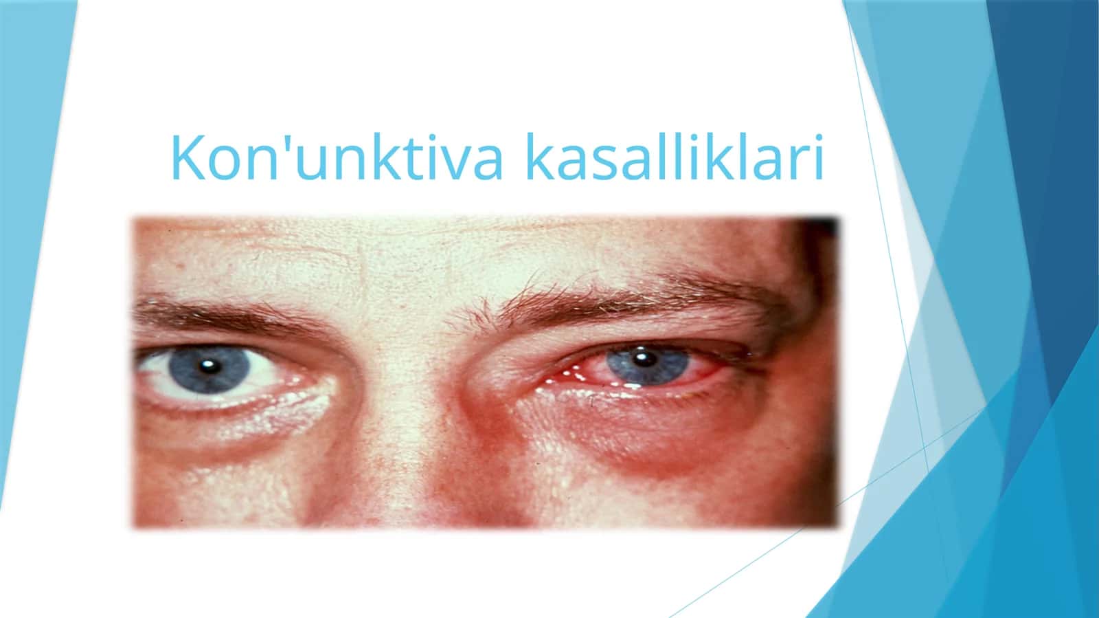 Kon'unktiva kasalliklari 1