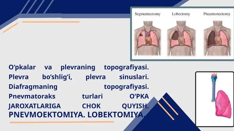 O‘pkalar va plevraning topografiyasi. Plevra bo’shlig’i, plevra sinuslari. Diafragmaning topografiyasi. Pnevmatoraks turlari O‘PKA JAROXATLARIGA CHOK QUYISH. PNEVMOEKTOMIYA. LOBEKTOMIYA. 1
