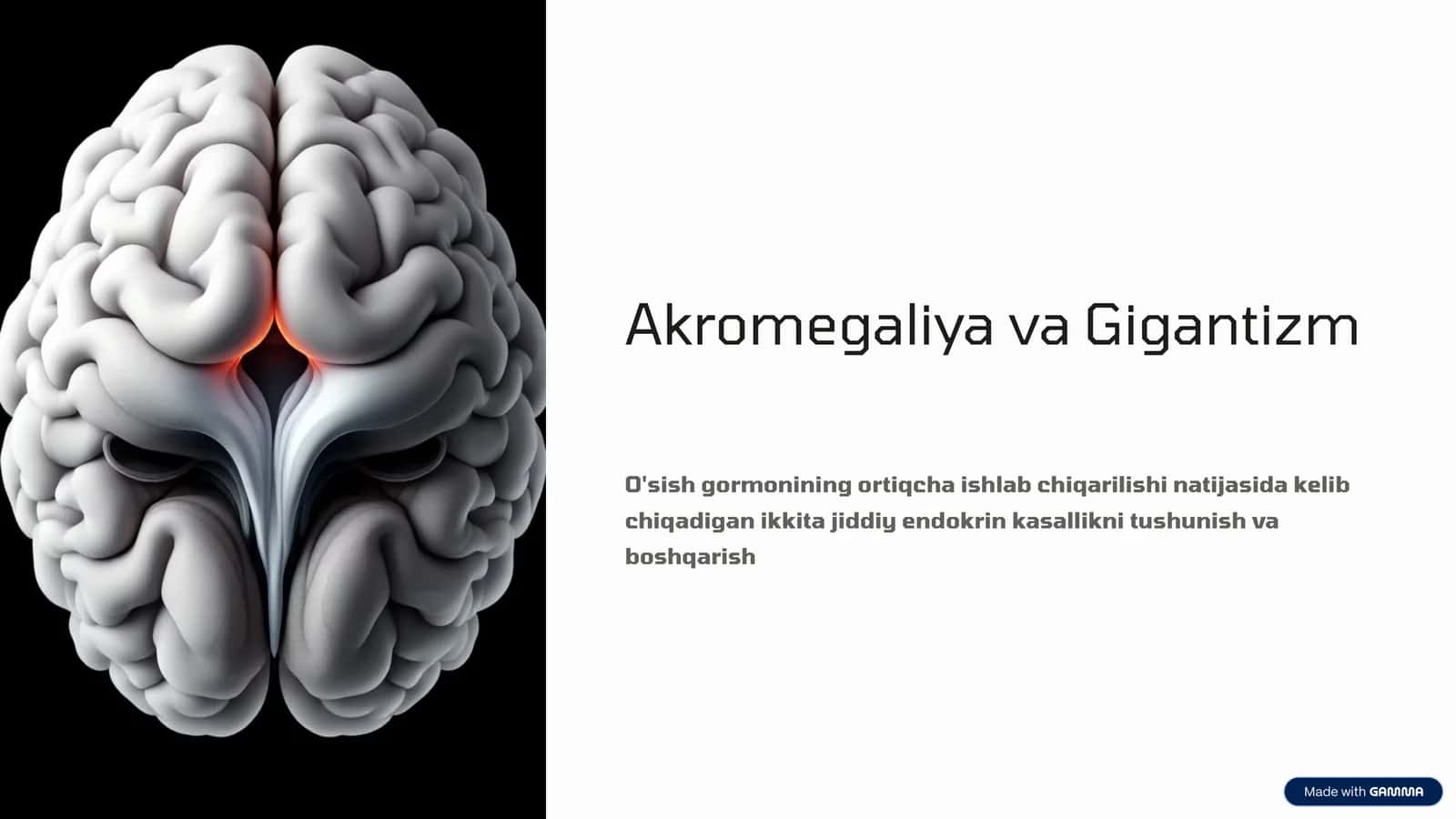 Akromegaliya va Gigantizm 1