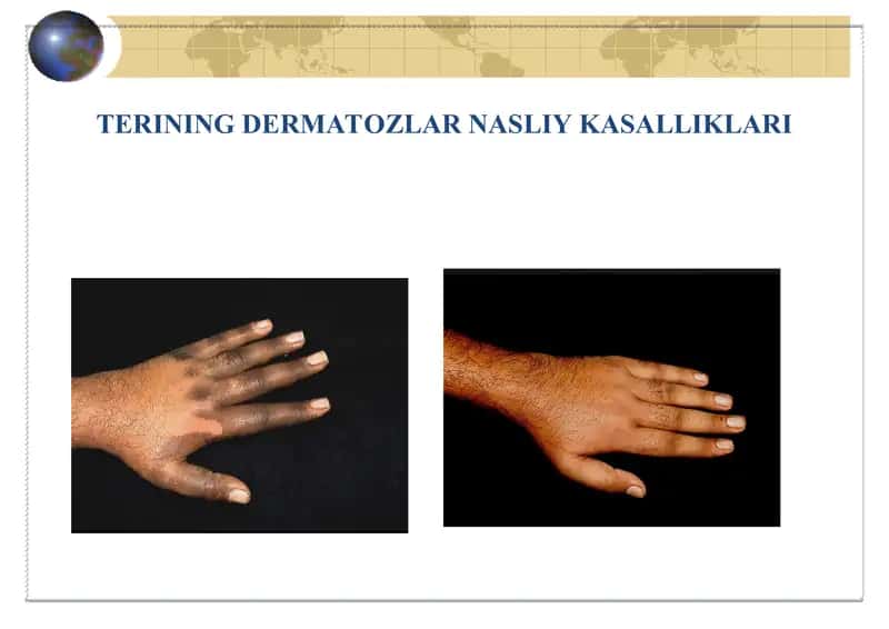Dermatozlar nasliy kasalliklari 1