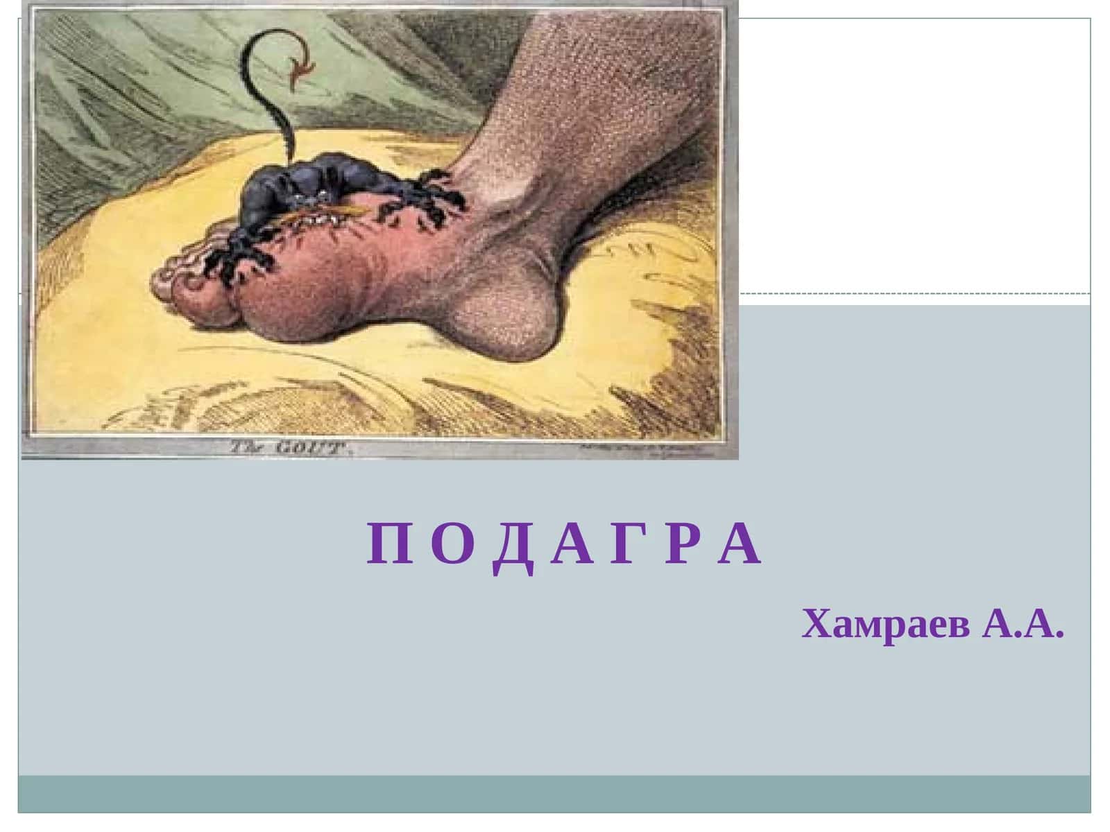 ПОДАГРА 1