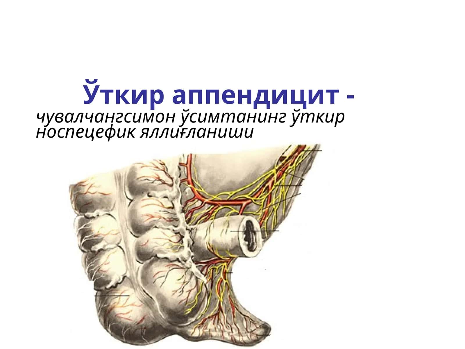 Ўткир аппендицит-чувалчангсимон ўсимтанинг ўткири носпецифик яллиғланиши 1