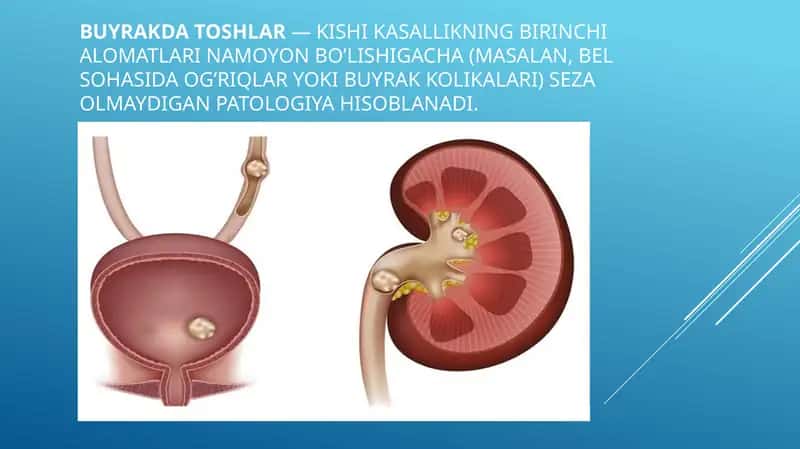 Siydik tosh kasalligi 1