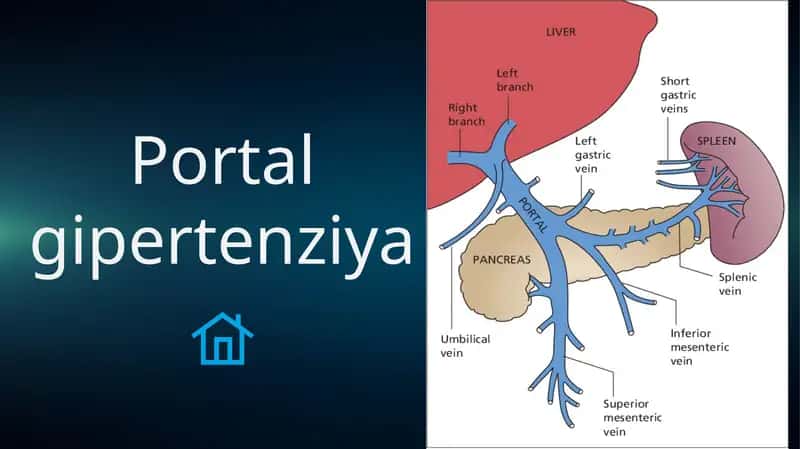 Portal gipertenziya sindromi 1