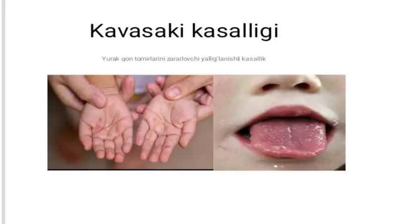 Kavasaki kasalligi 1