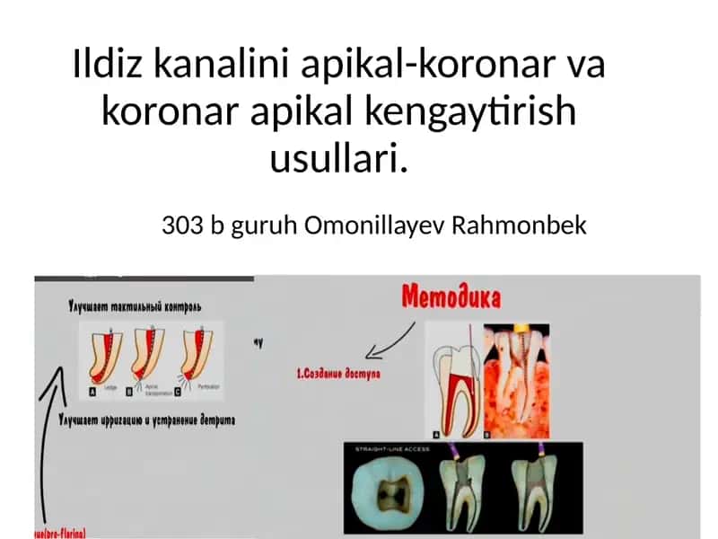 Ildiz kanalini apikal-koronar va koronar apikal kengaytirish usullari. 1