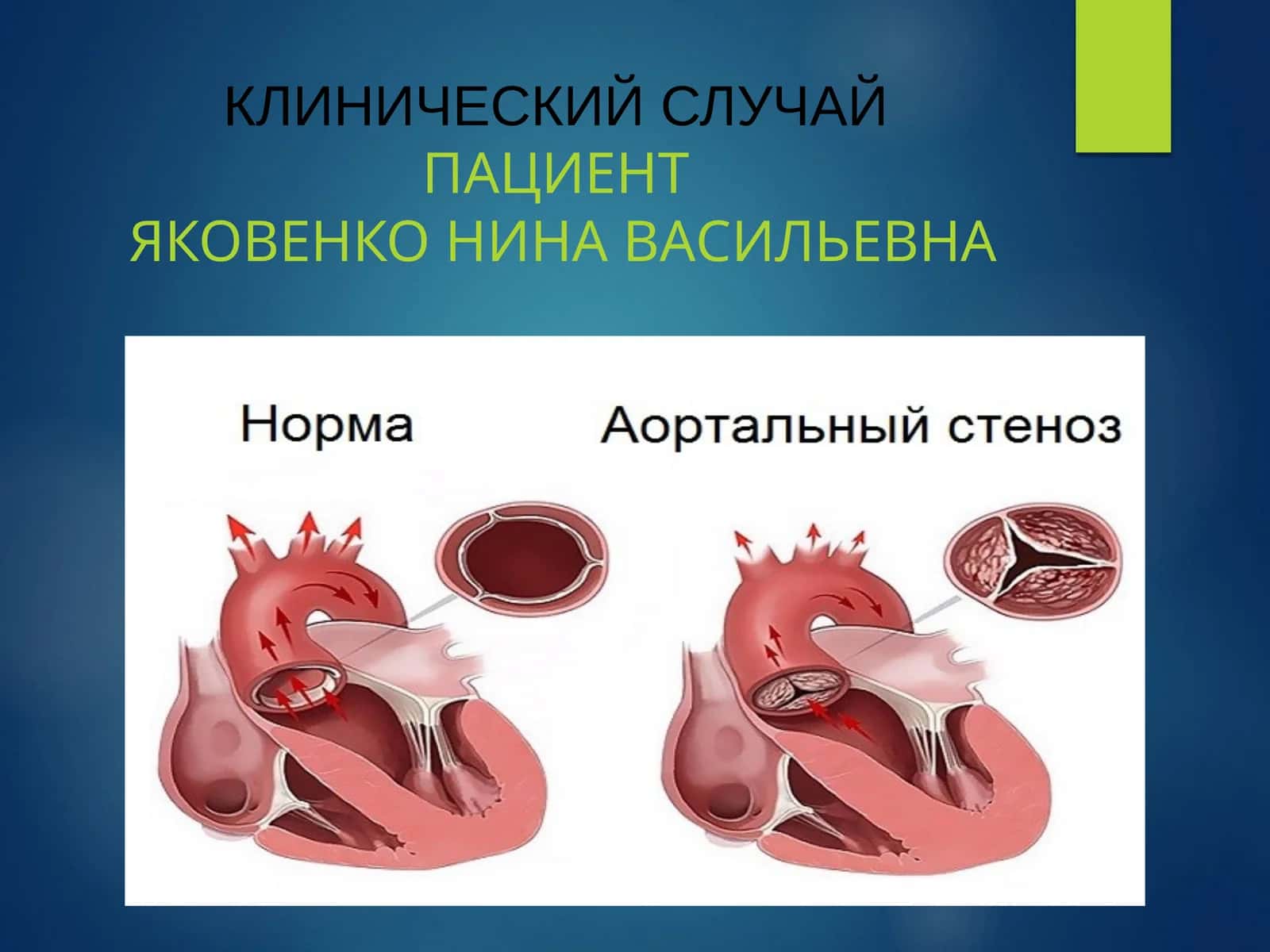 КЛИНИЧЕСКИЙ СЛУЧАЙПАЦИЕНТЯКОВЕНКО НИНА ВАСИЛЬЕВНА 1