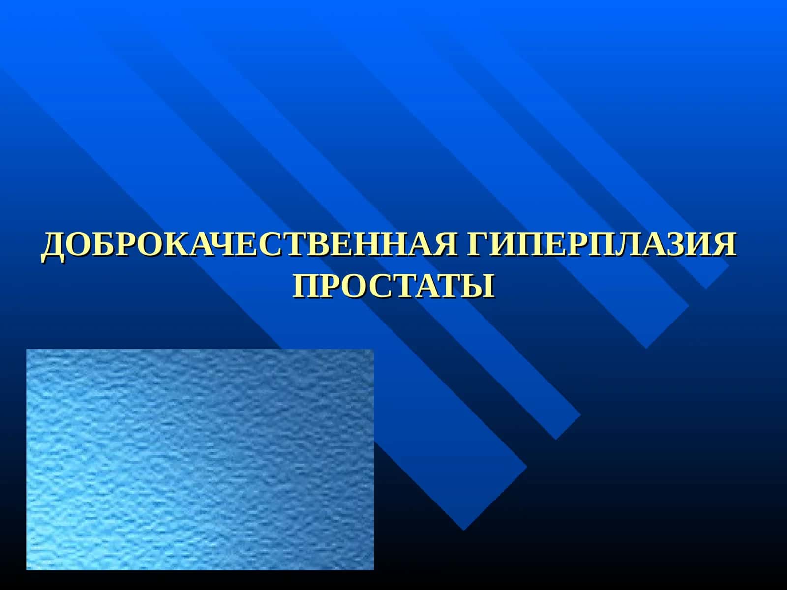 ДОБРОКАЧЕСТВЕННАЯ ГИПЕРПЛАЗИЯ ПРОСТАТЫ 1