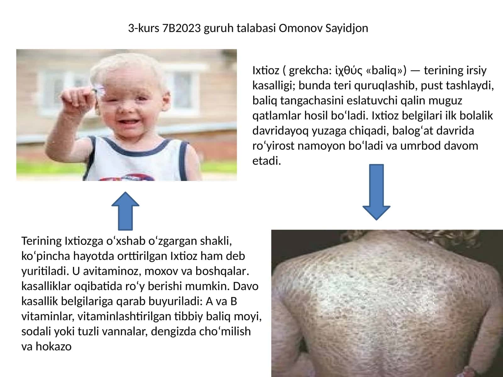 Ixtioz va gipertirixoz 1
