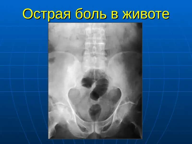 Острая боль в животе 1