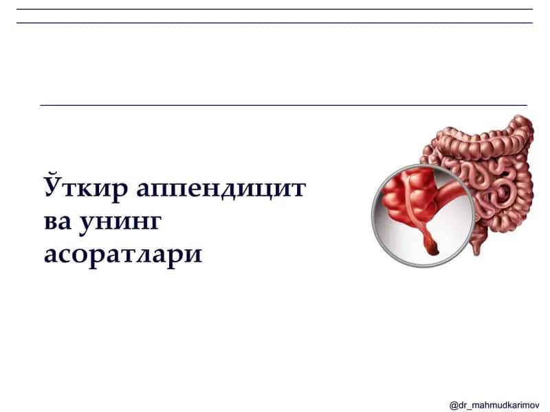 Ўткир аппендицит ва унинг асоратлари 1