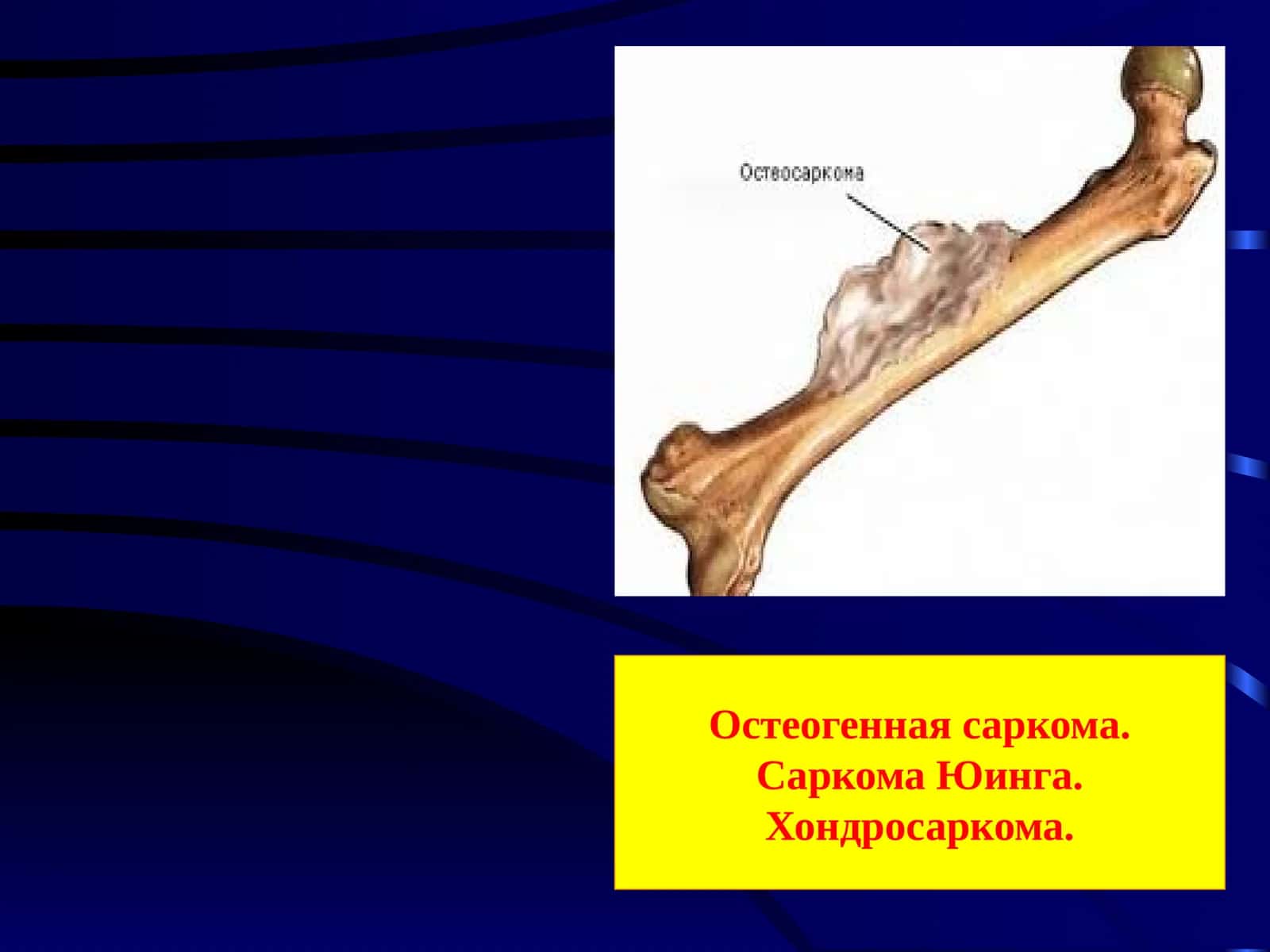 Остеогенная саркома. Саркома Юинга. Хондросаркома 1