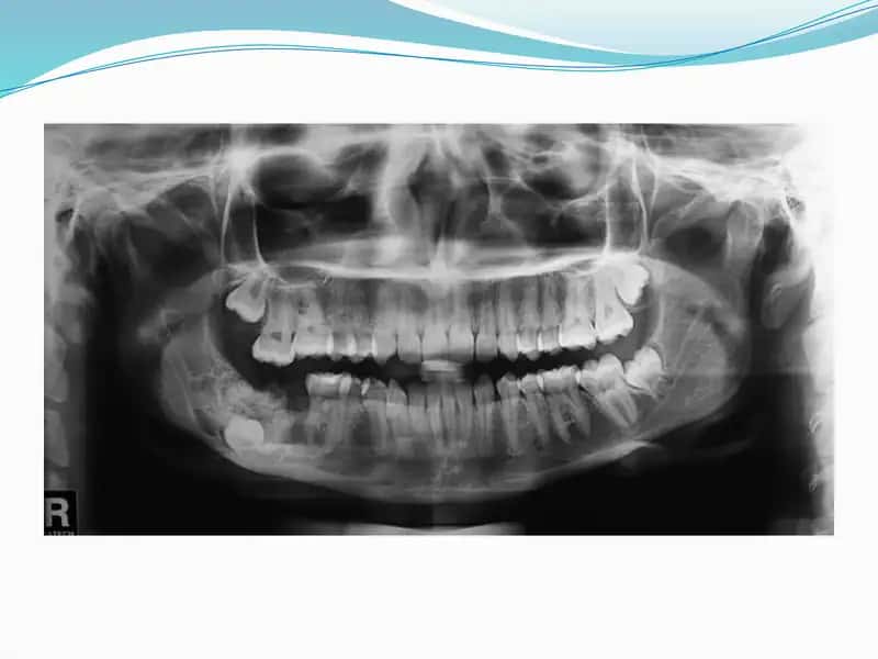 Specialized treatment for tooth extraction and surgery 1