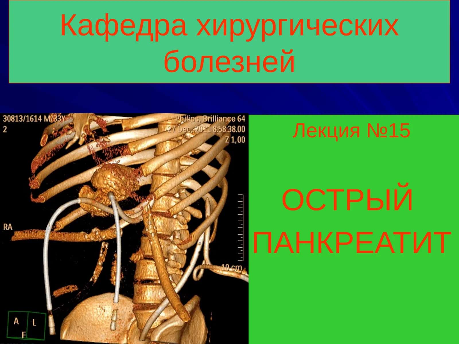 ОСТРЫЙ ПАНКРЕАТИТ 1