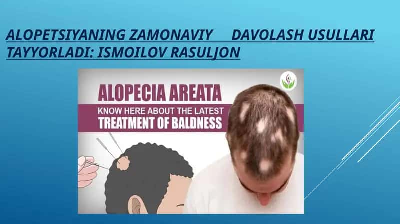 ALOPETSIYANING ZAMONAVIY DAVOLASH USULLARI 1