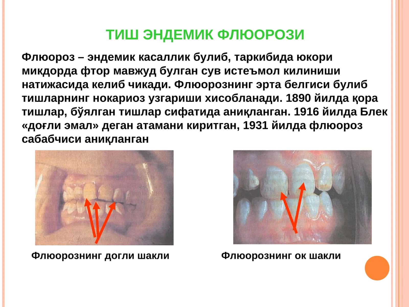 Тиш эндемик флюорози 1