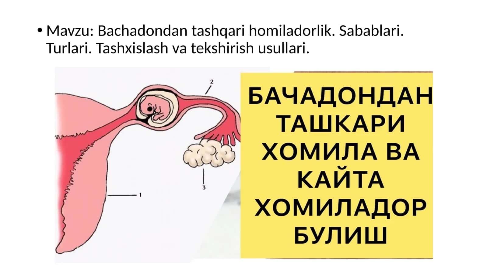 Bachadon-dantashqari homiladorlik 1