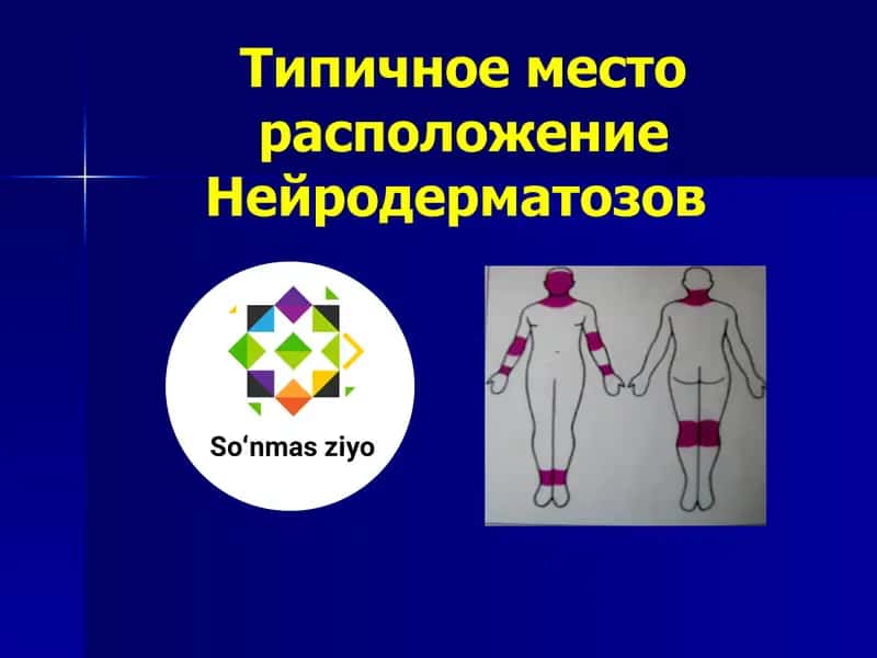 Типичное место расположение Нейродерматозов 1
