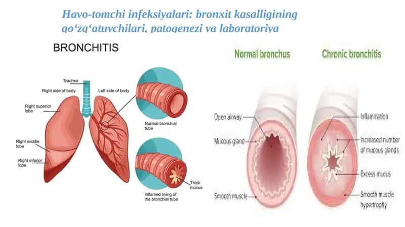 Havo-tomchi infeksiyalari: bronxit kasalligining qo‘zg‘atuvchilari, patogenezi va laboratoriya tashhisi 1