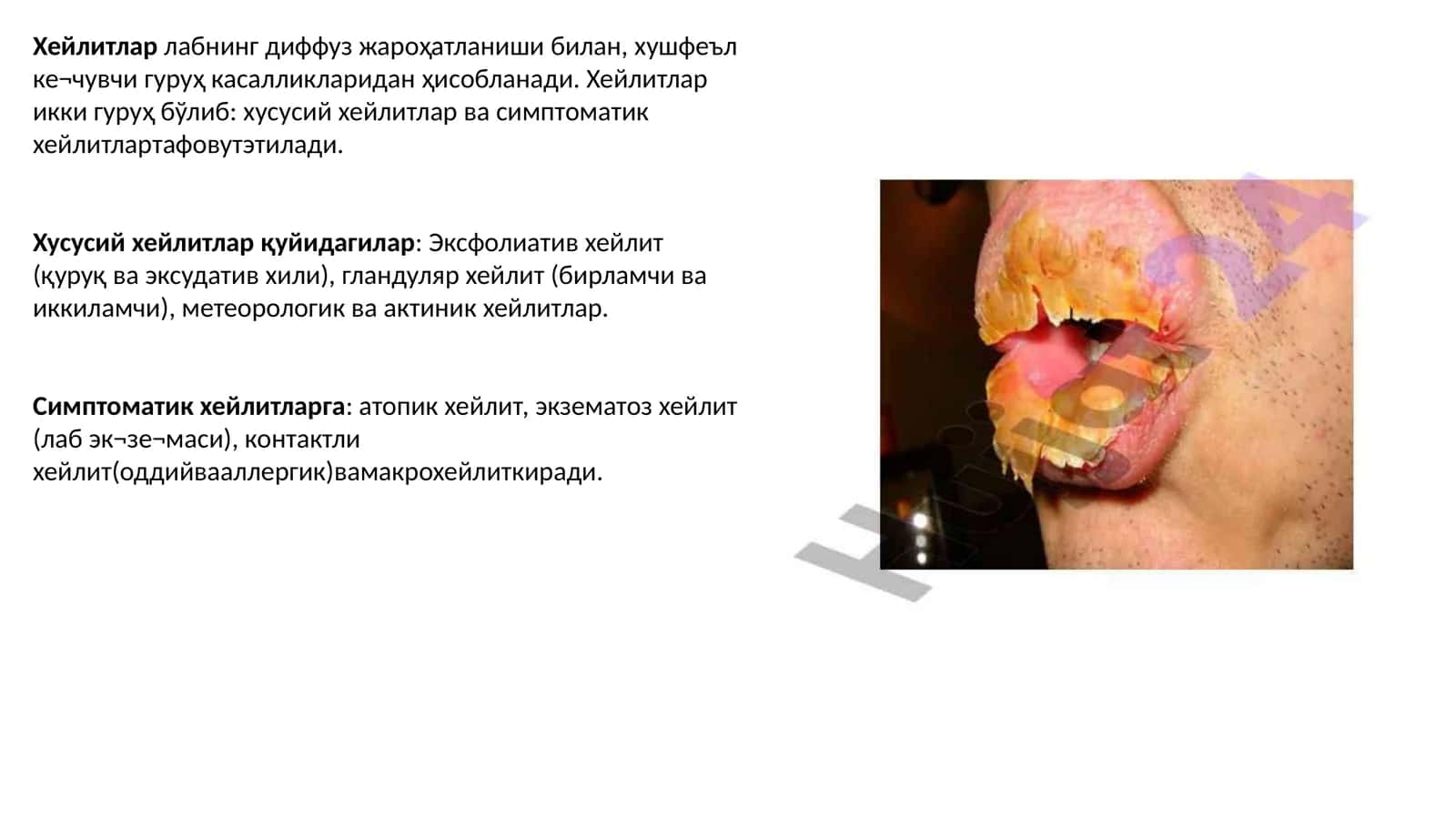 Қуруқ ва эксудатив ҳейлит 1