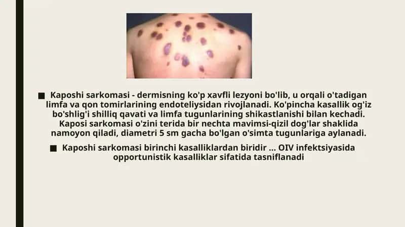 Kaposi sarkomasi 1