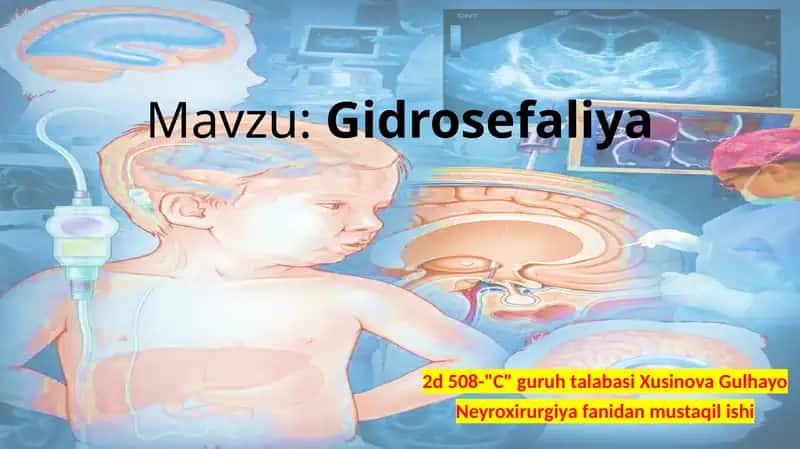 Gidrosefaliya 1