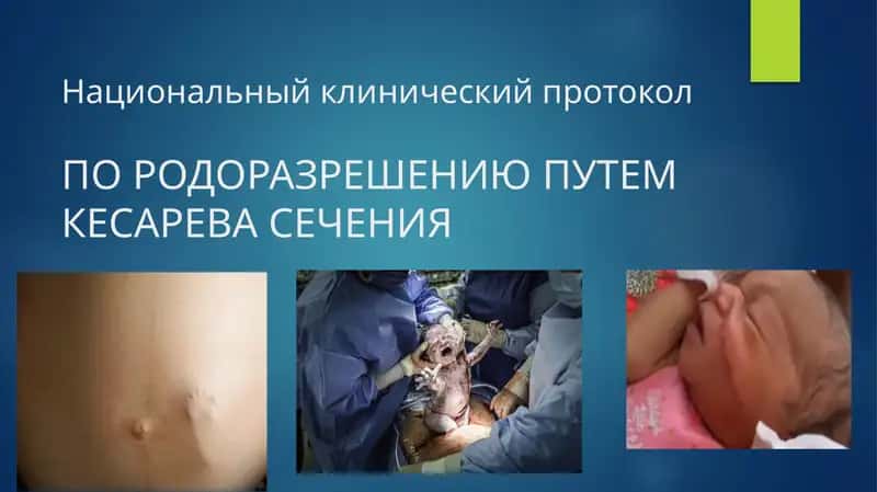 Национальный клинический протокол ПО РОДОРАЗРЕШЕНИЮ ПУТЕМ КЕСАРЕВА СЕЧЕНИЯ 1
