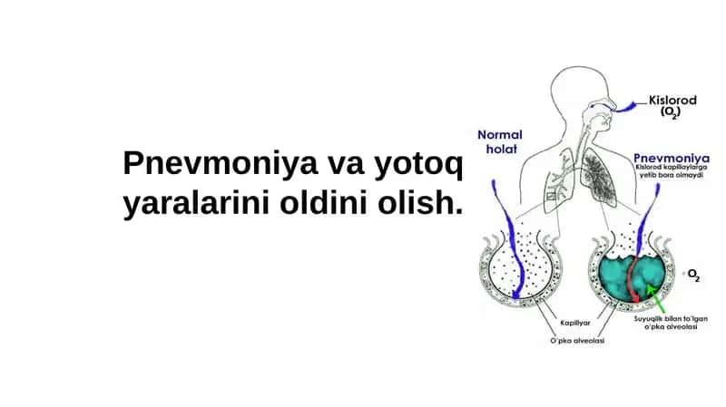 Pnevmoniya va yotoq yaralarini oldiniolish 1